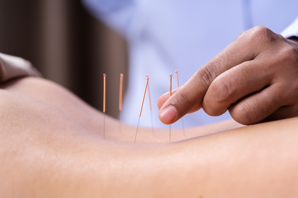 leczenie akupunkturą Częstochowa